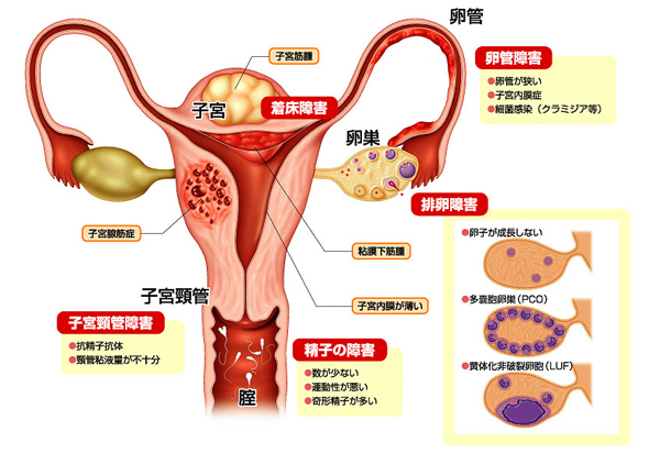 卵巣 の 腫れ 原因